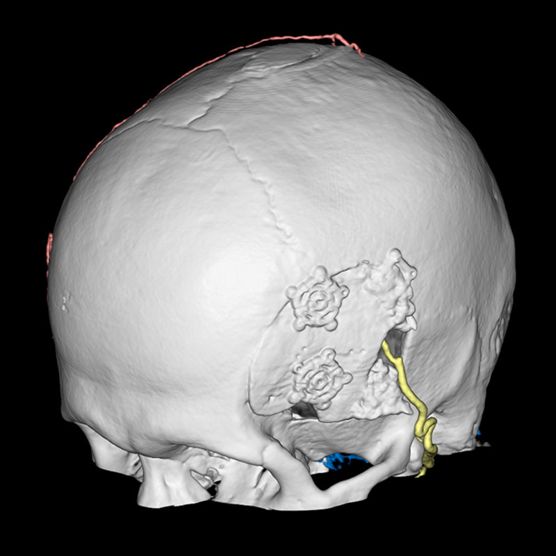 4DCT DSA, Desvio Cerebral