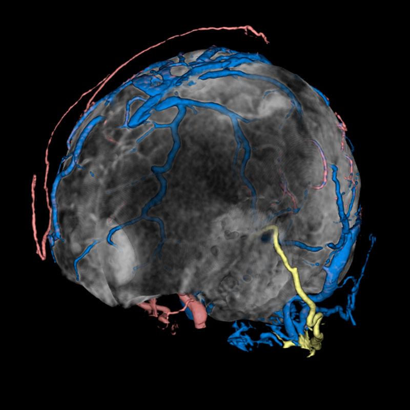 4DCT DSA, Desvio Cerebral