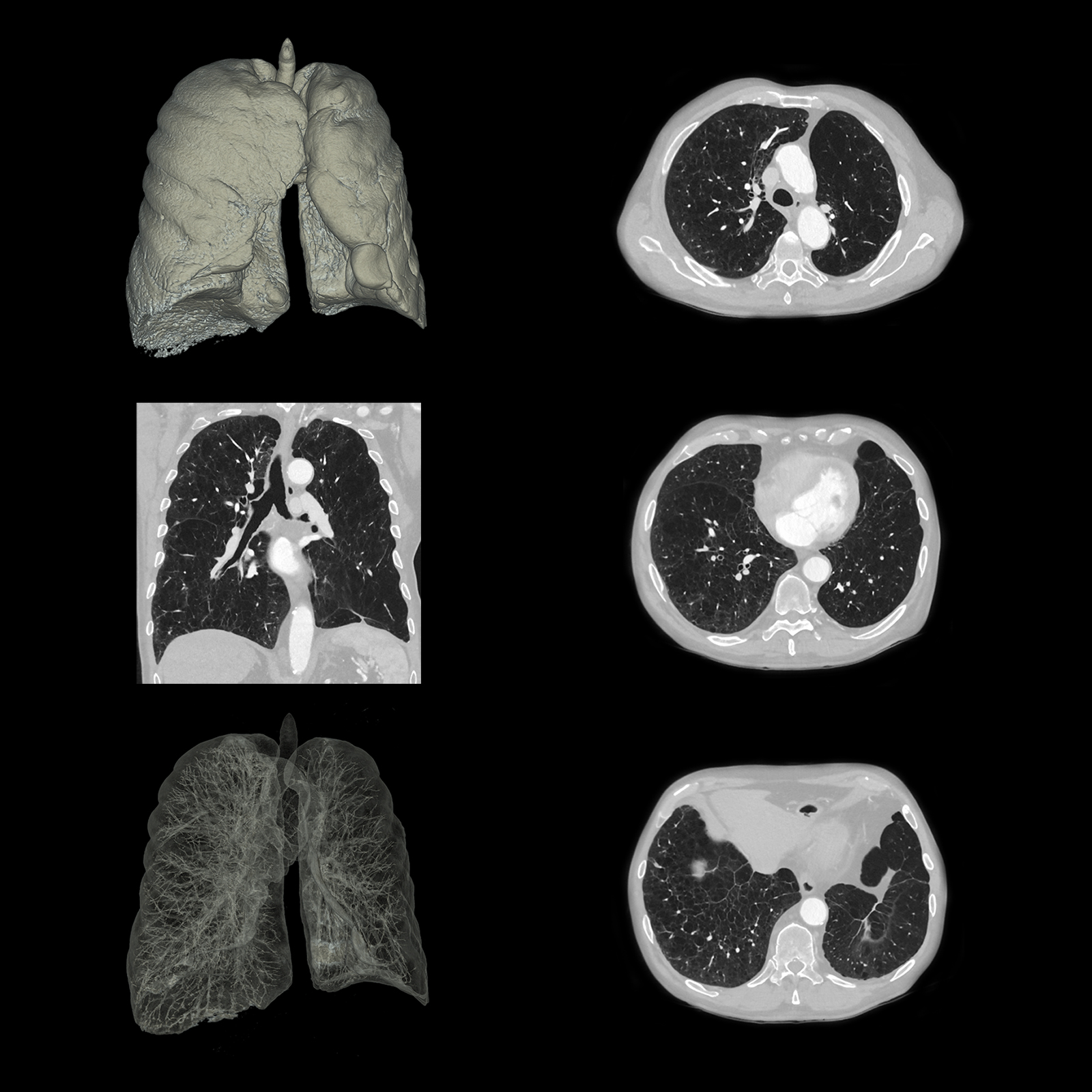 Enfisema pulmonar, AiCE