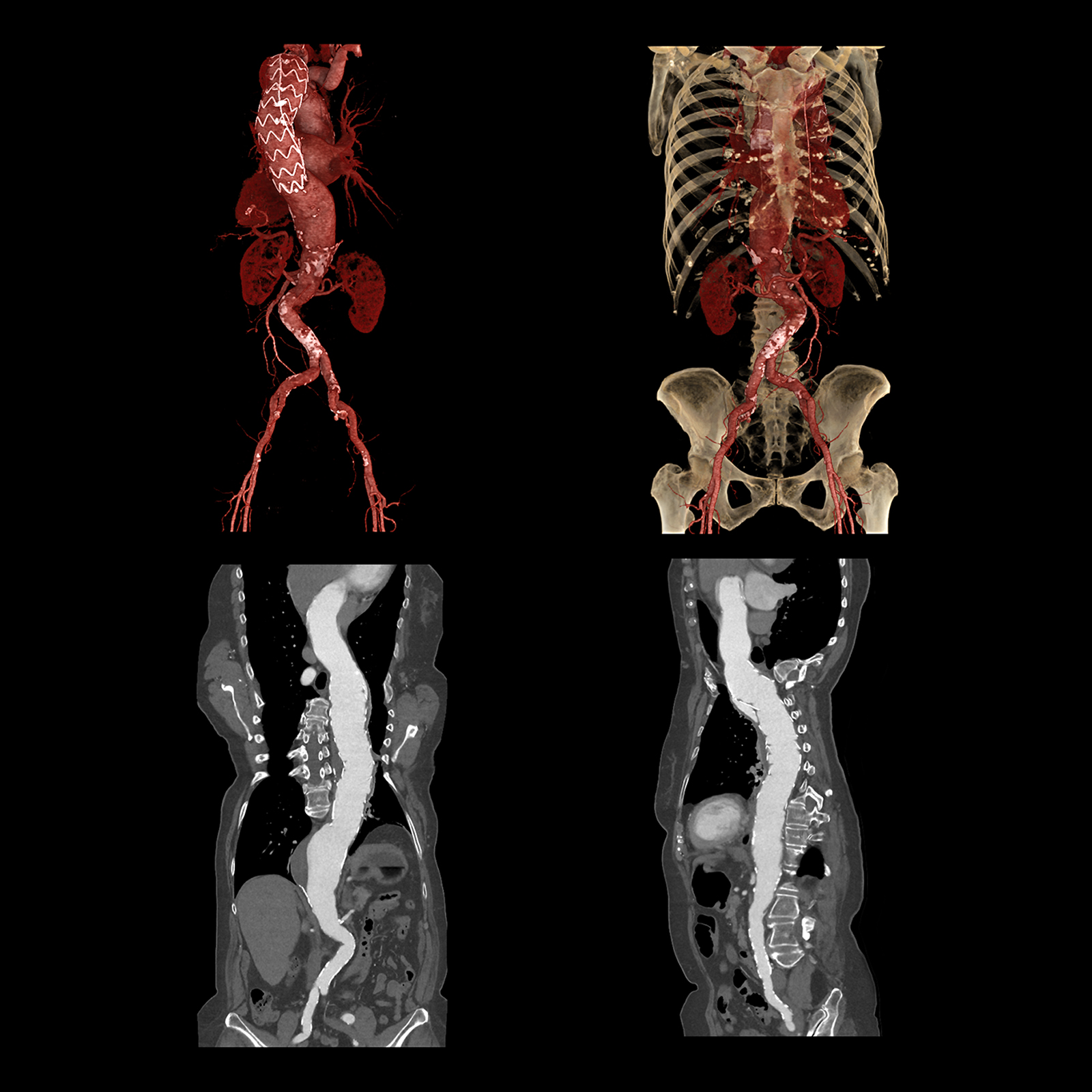 Acompanhamento de Stent de Aorta Torácica, AiCE