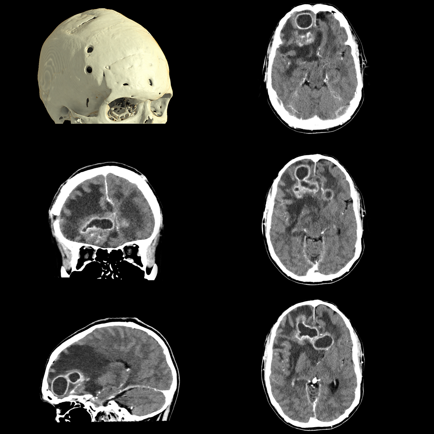 Abcessos cerebrais, AiCE