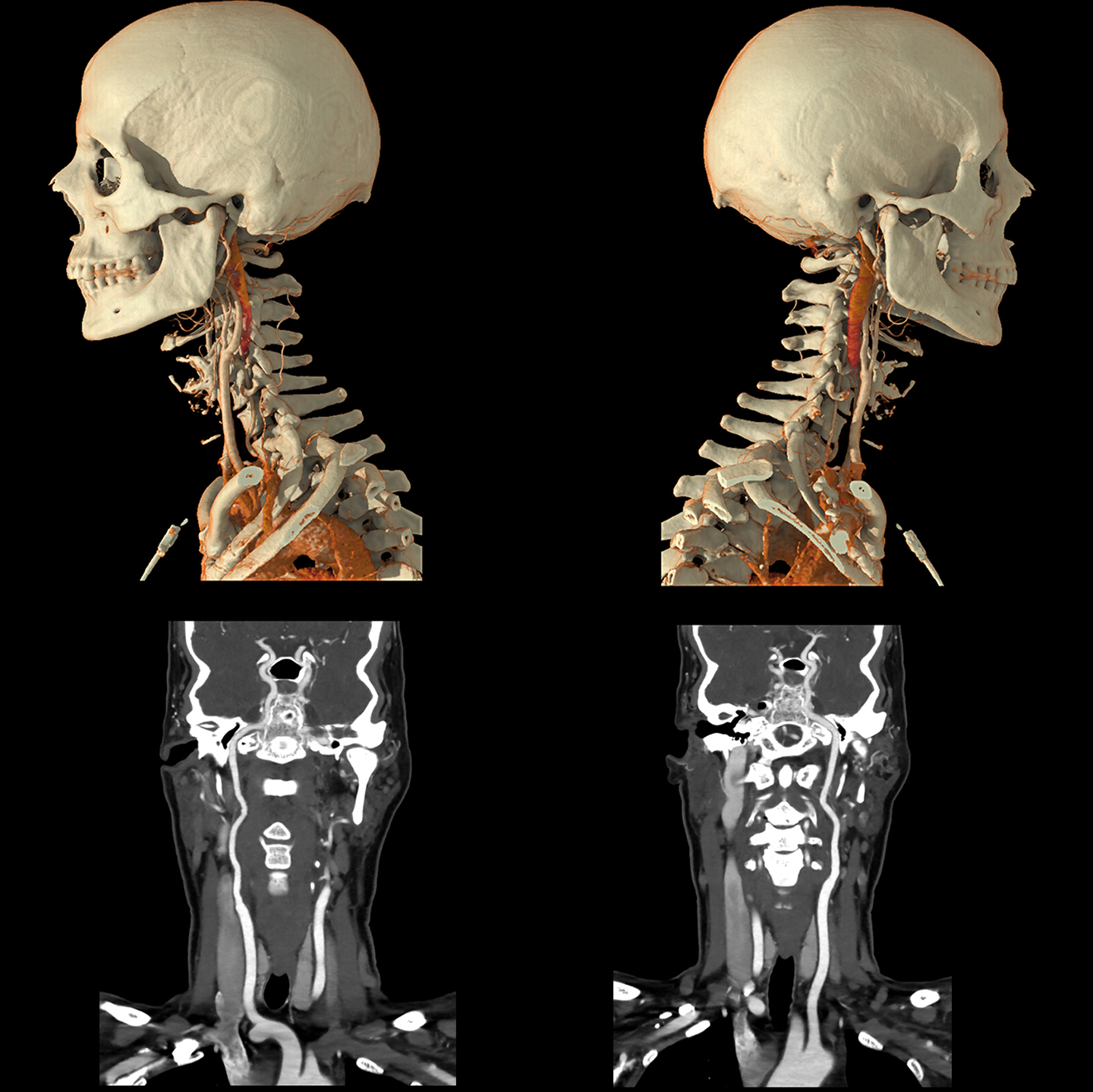 Angiografia Carotídea, AiCE