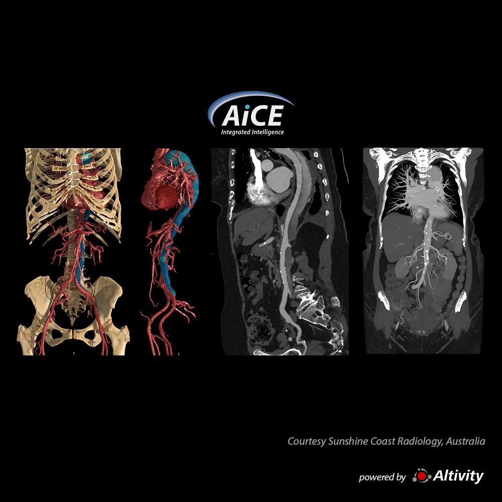 Aorta CTA - Dissecção