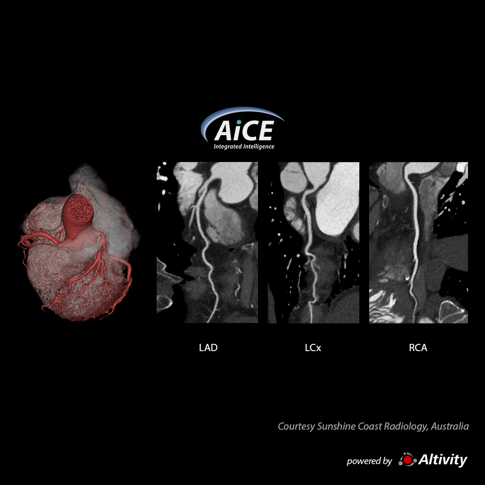 Cardiac 1.8mSv