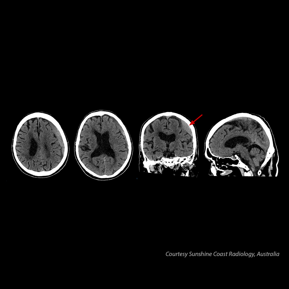 Cérebro - Hematoma subdural